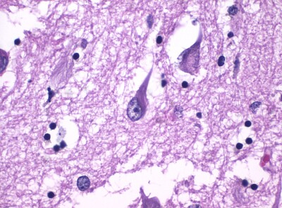 Histopathology of Neurofibrillary Tangles